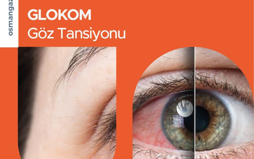Göz Tansiyonu (Glokom) Tedavisi Nasıl Gerçekleşir?